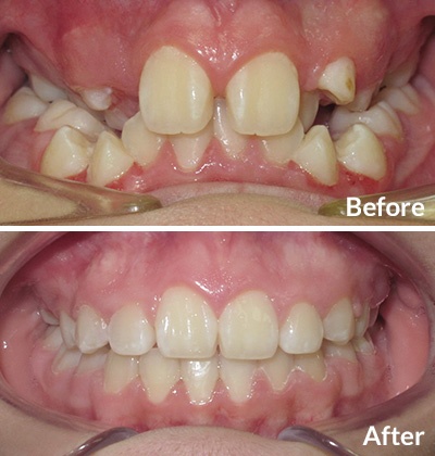 Smile Gallery  Houston Orthodontic Specialists